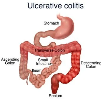 Ulcerative Colitis: Digestive System Anatomy