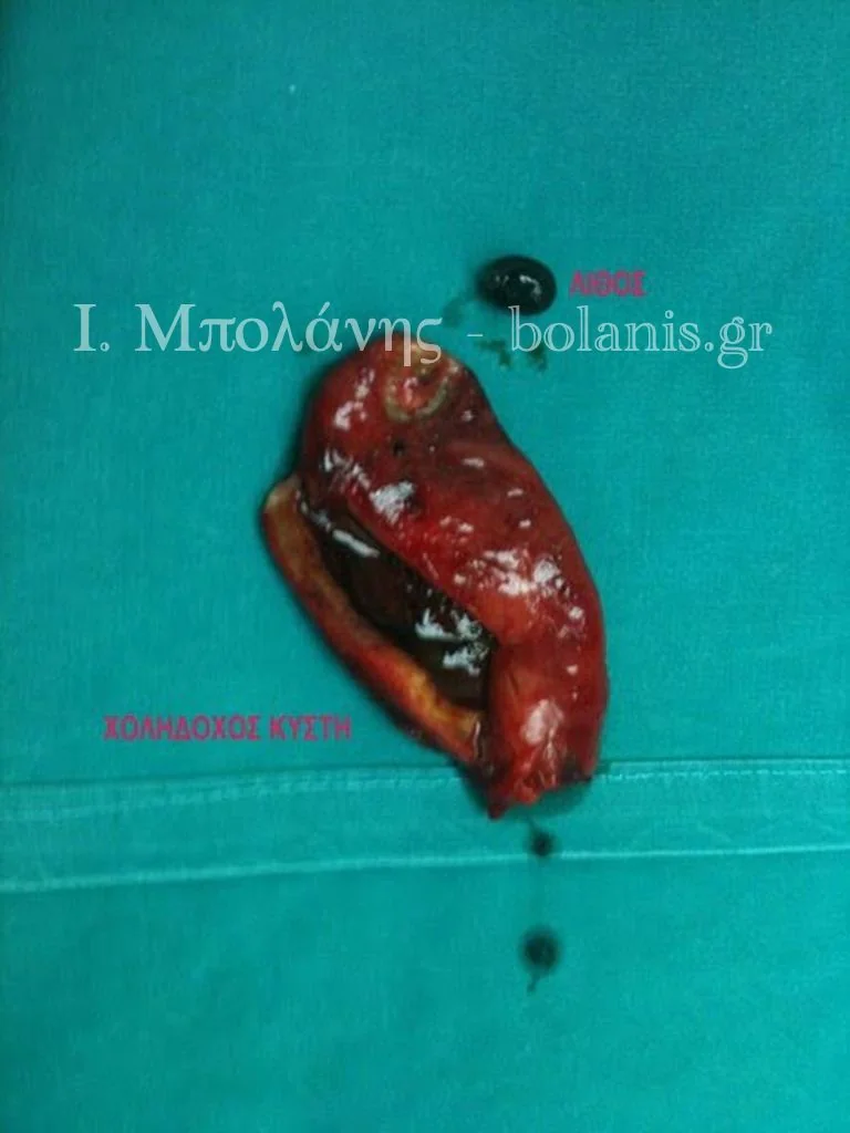 Laparoscopic cholecystectomy - xolh 1