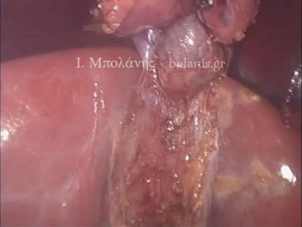 Laparoscopic cholecystectomy - xolh 10