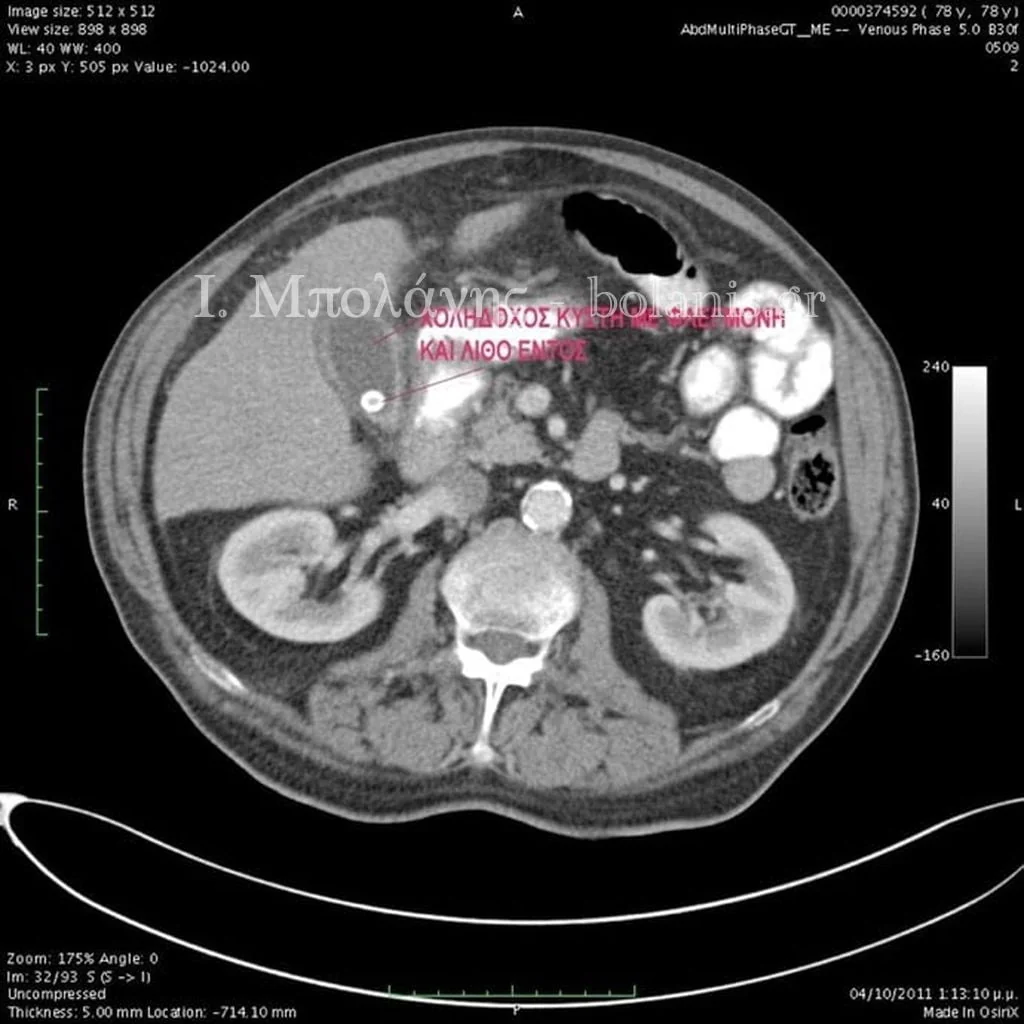 Laparoscopic cholecystectomy - xolh 2