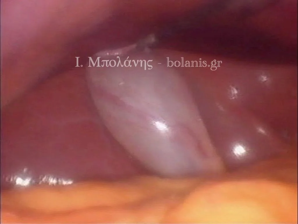 Laparoscopic cholecystectomy - xolh 3
