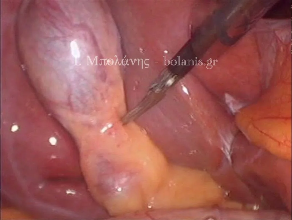Laparoscopic cholecystectomy - xolh 4