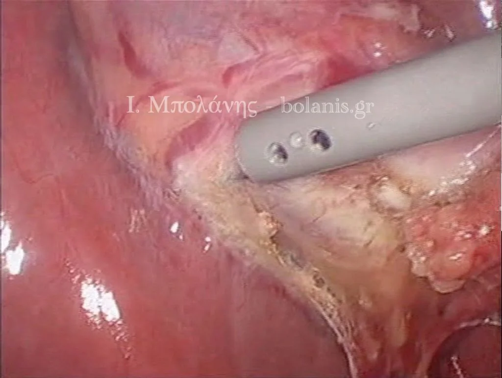 Laparoscopic cholecystectomy - xolh 5