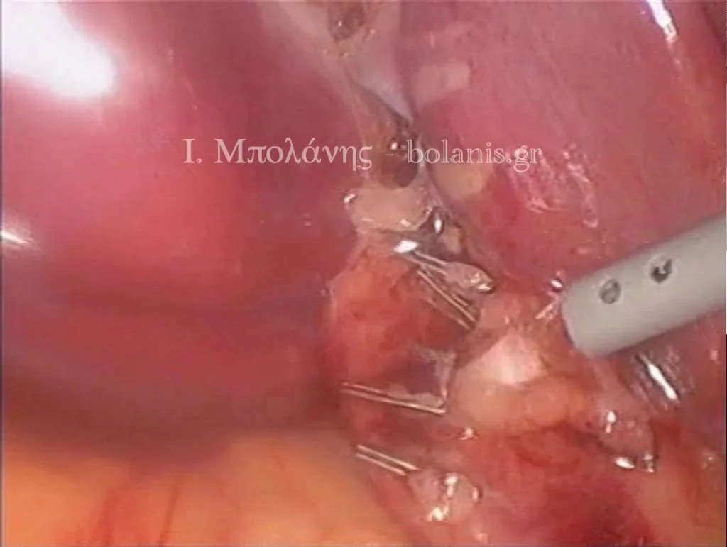 Laparoscopic cholecystectomy - xolh 6