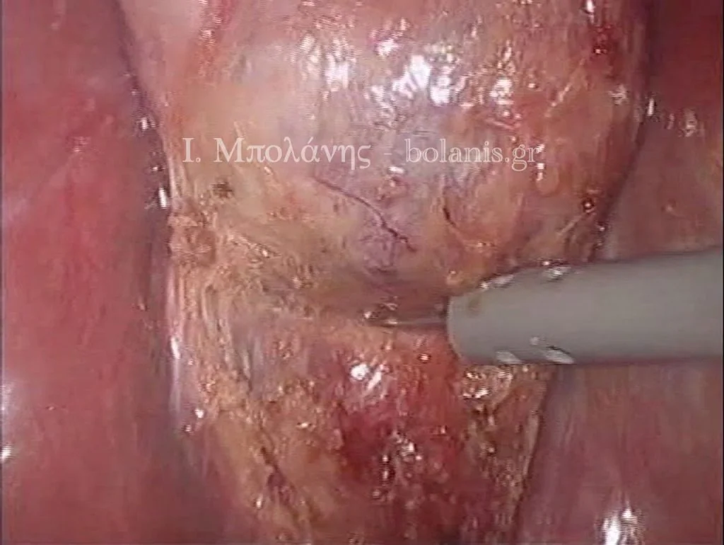 Laparoscopic cholecystectomy - xolh 7