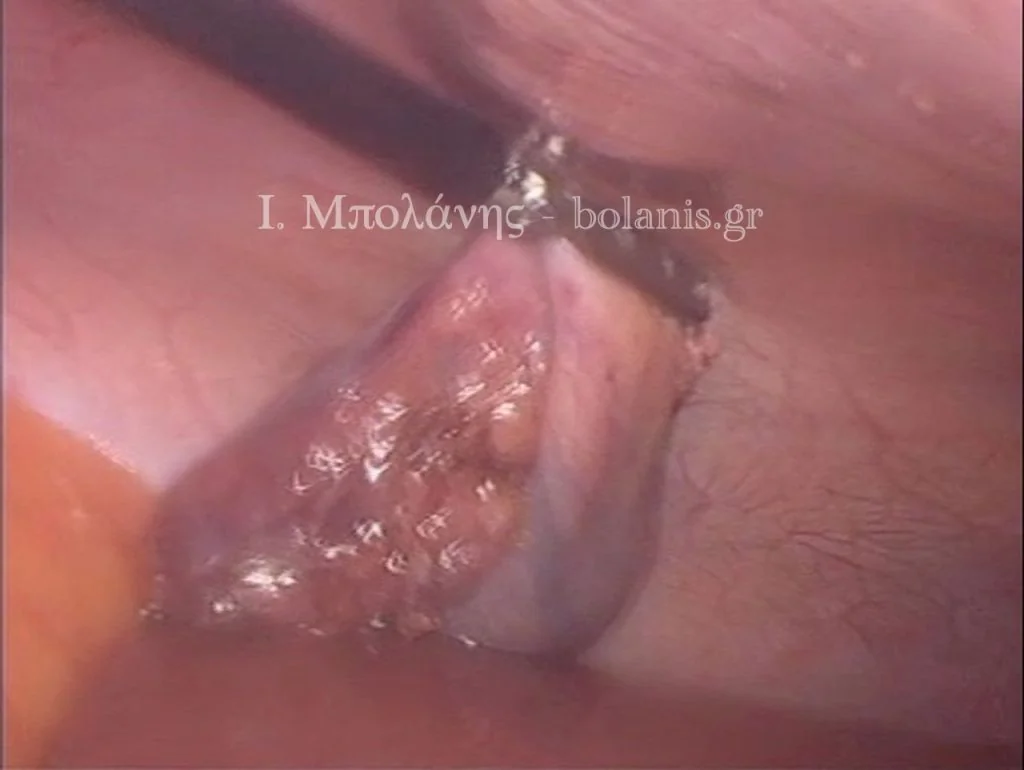 Laparoscopic cholecystectomy - xolh 8