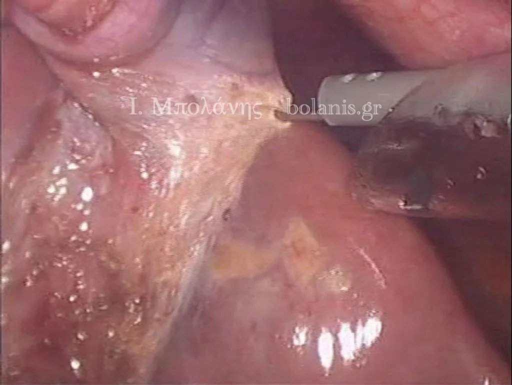 Laparoscopic cholecystectomy - xolh 9
