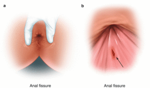 Ραγάδα πρωκτού laser botox